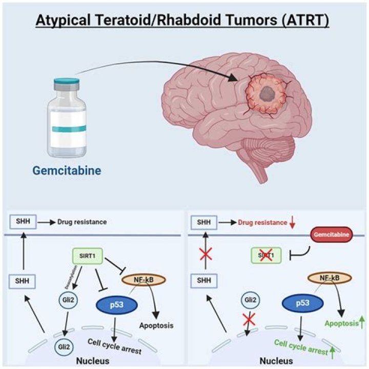 All You Need to Know About Atypical Teratoid Rhabdoid Tumor (ATRT)